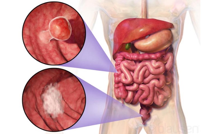 Diagnosis dan Pengobatan Kanker Kolorektal